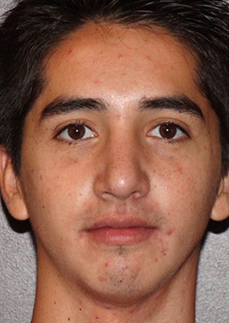 Rhinoplasty Before & After Gallery - Patient 106569294 - Image 6