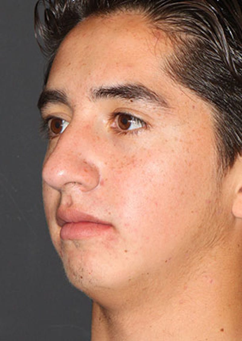 Rhinoplasty Before & After Gallery - Patient 106569294 - Image 7