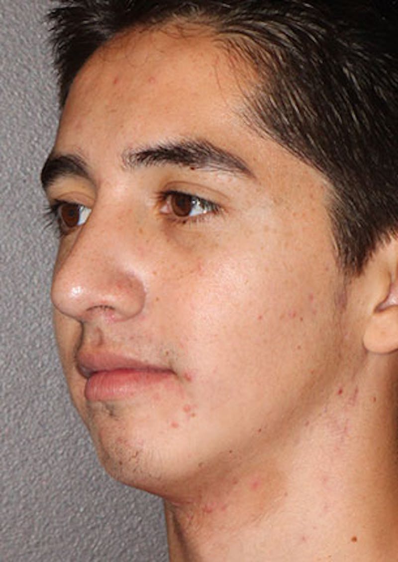Rhinoplasty Before & After Gallery - Patient 106569294 - Image 8