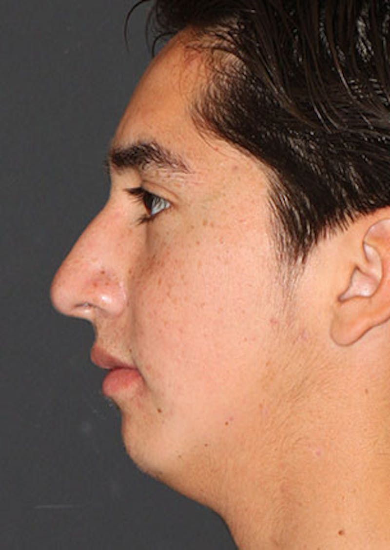 Rhinoplasty Before & After Gallery - Patient 106569294 - Image 9