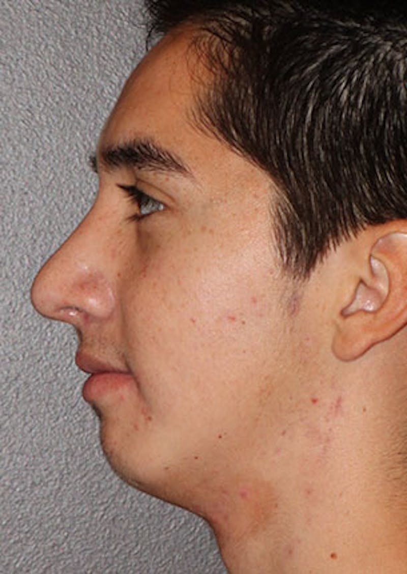 Rhinoplasty Before & After Gallery - Patient 106569294 - Image 10