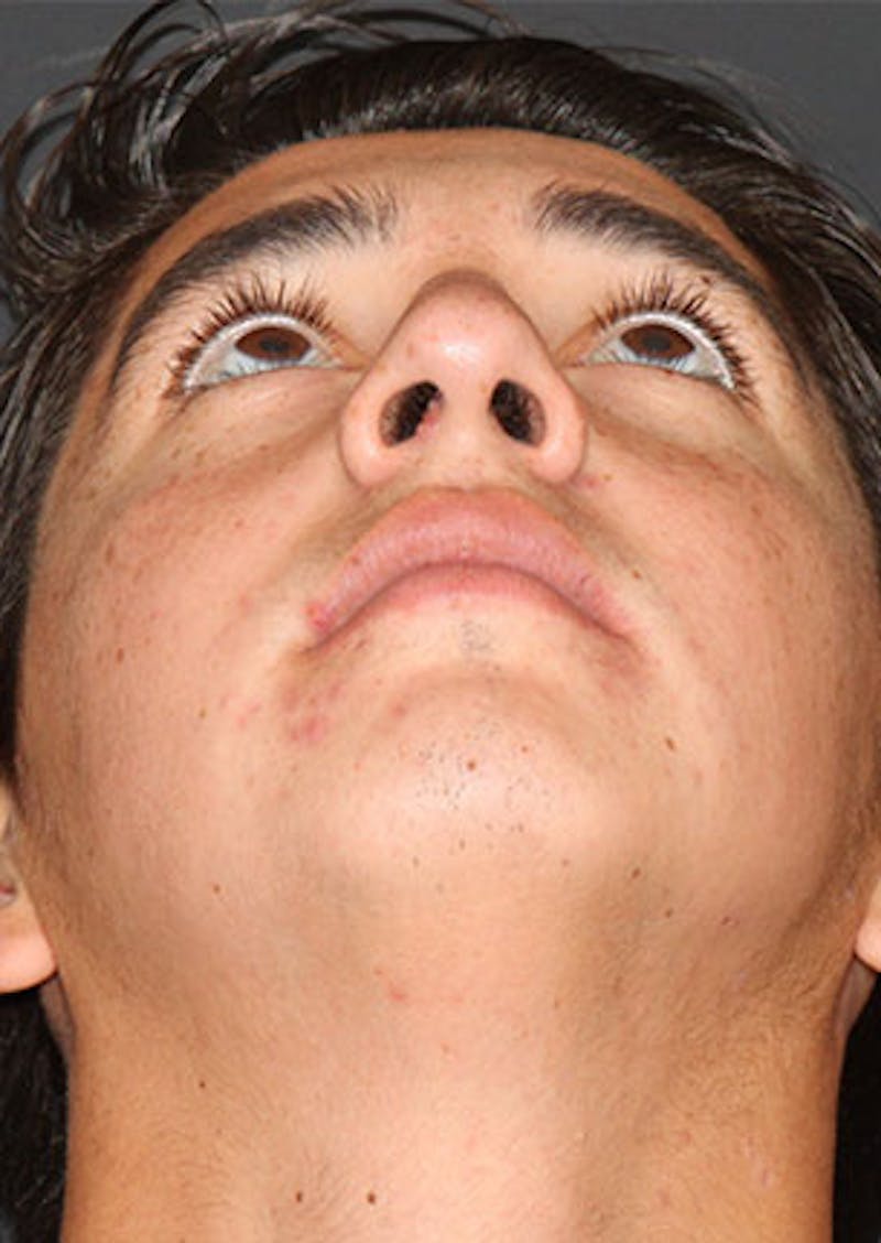 Rhinoplasty Before & After Gallery - Patient 106569294 - Image 11