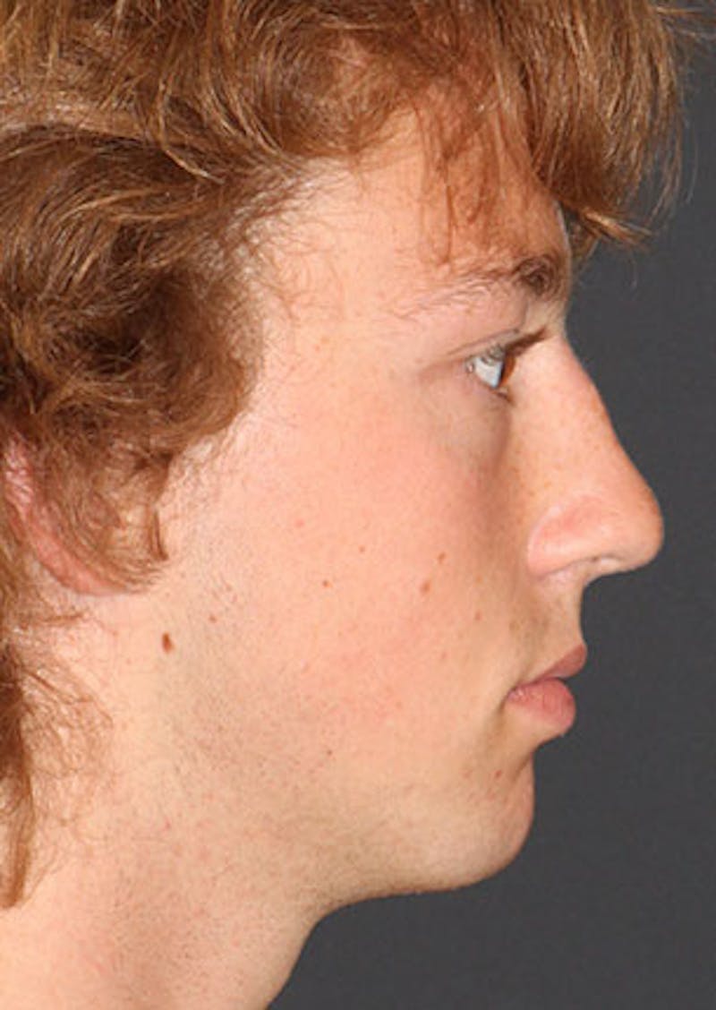 Rhinoplasty Before & After Gallery - Patient 106569327 - Image 1