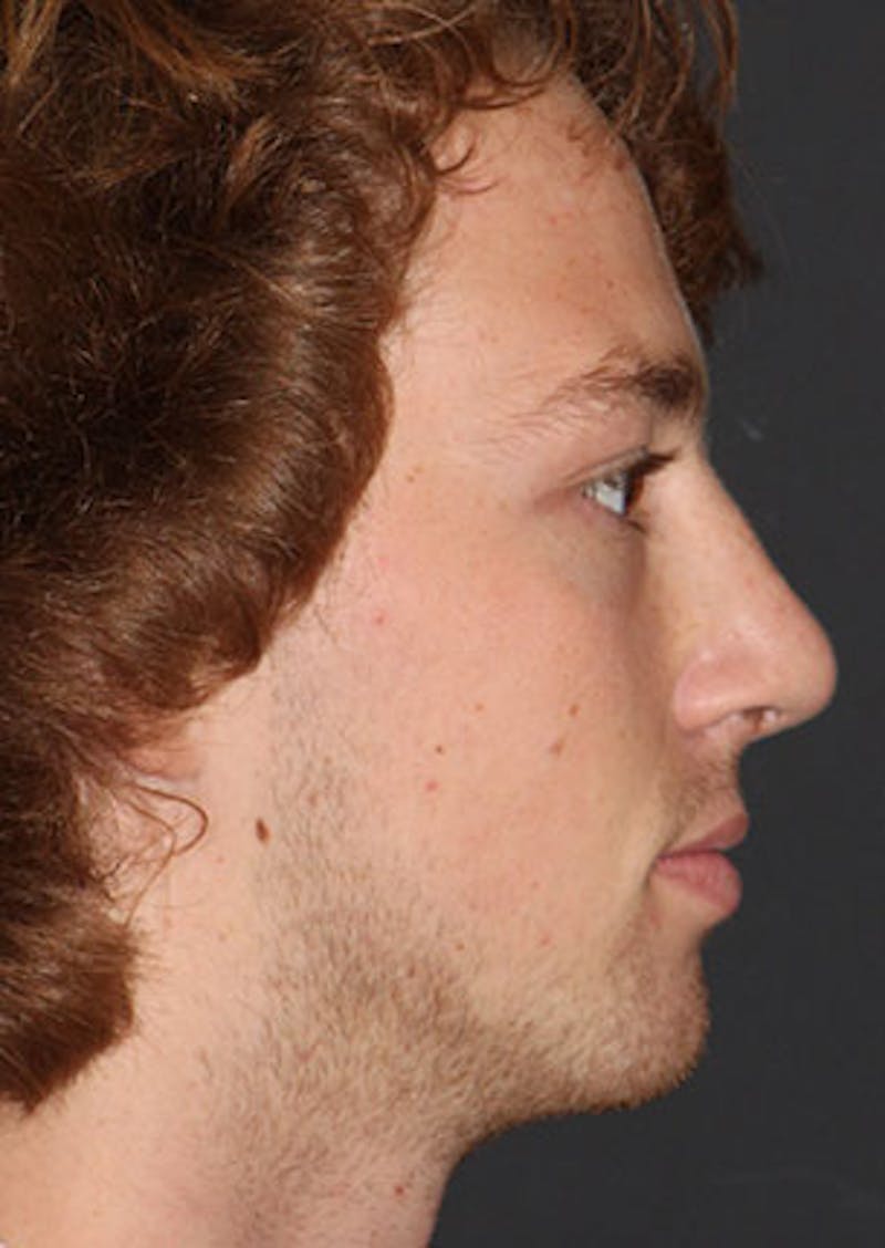 Rhinoplasty Before & After Gallery - Patient 106569327 - Image 2