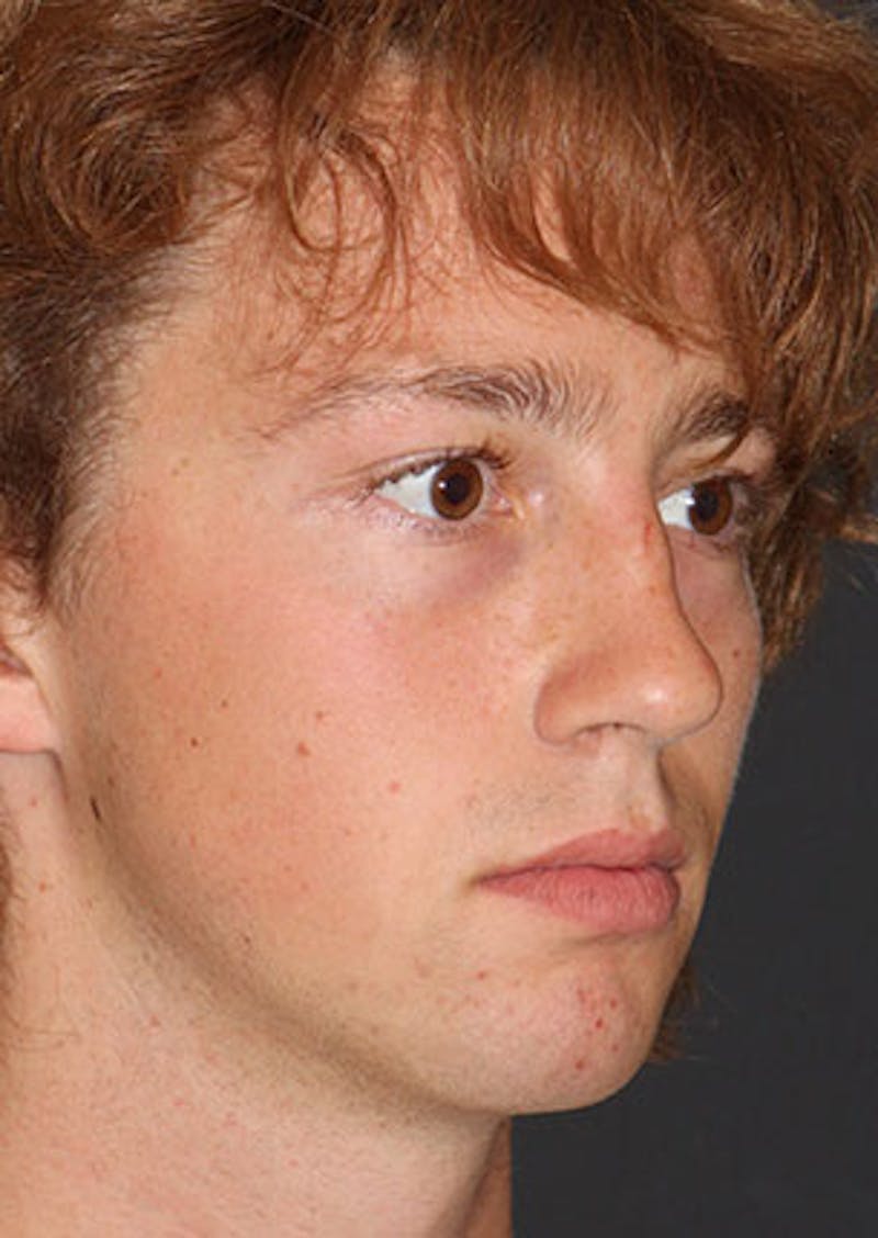 Rhinoplasty Before & After Gallery - Patient 106569327 - Image 3