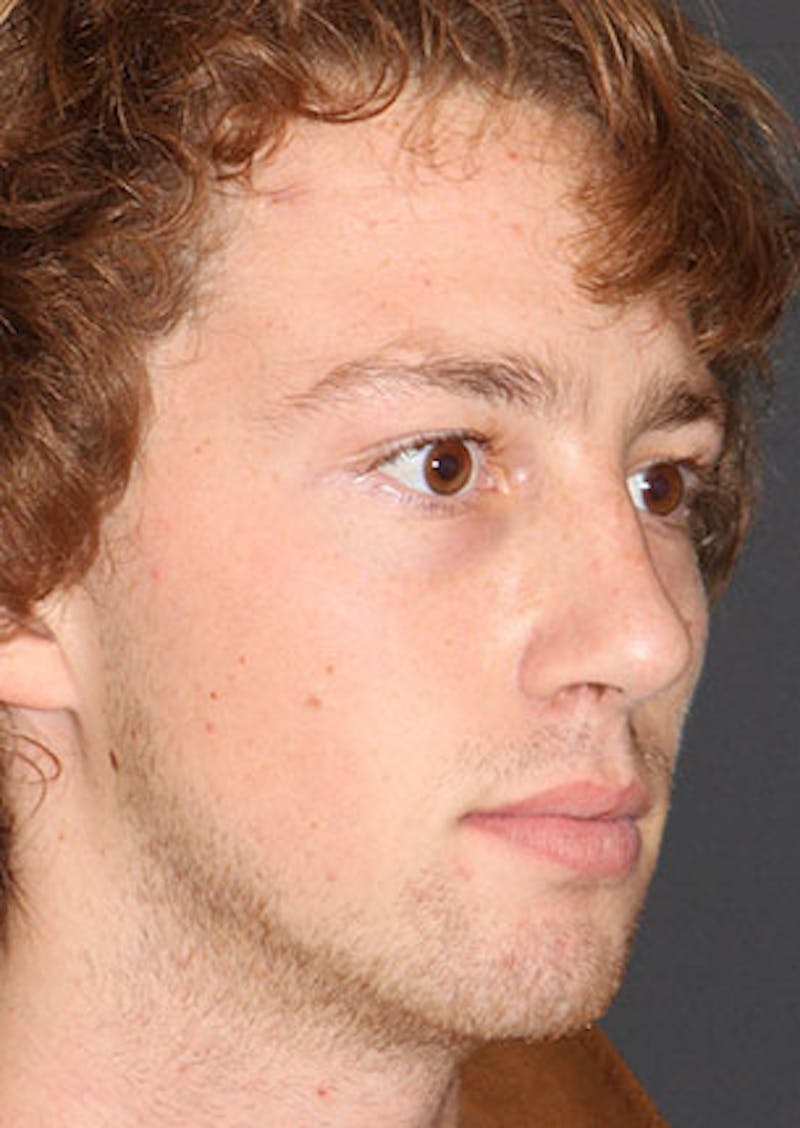 Rhinoplasty Before & After Gallery - Patient 106569327 - Image 4