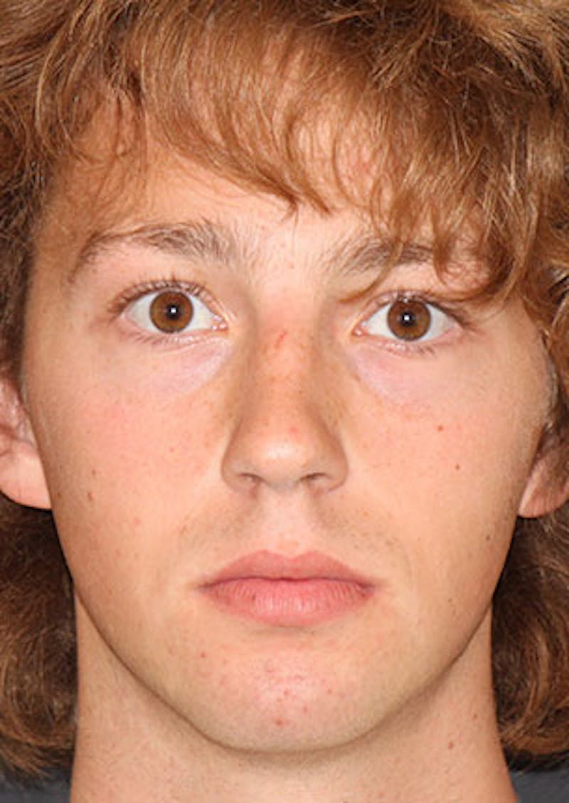 Rhinoplasty Before & After Gallery - Patient 106569327 - Image 5
