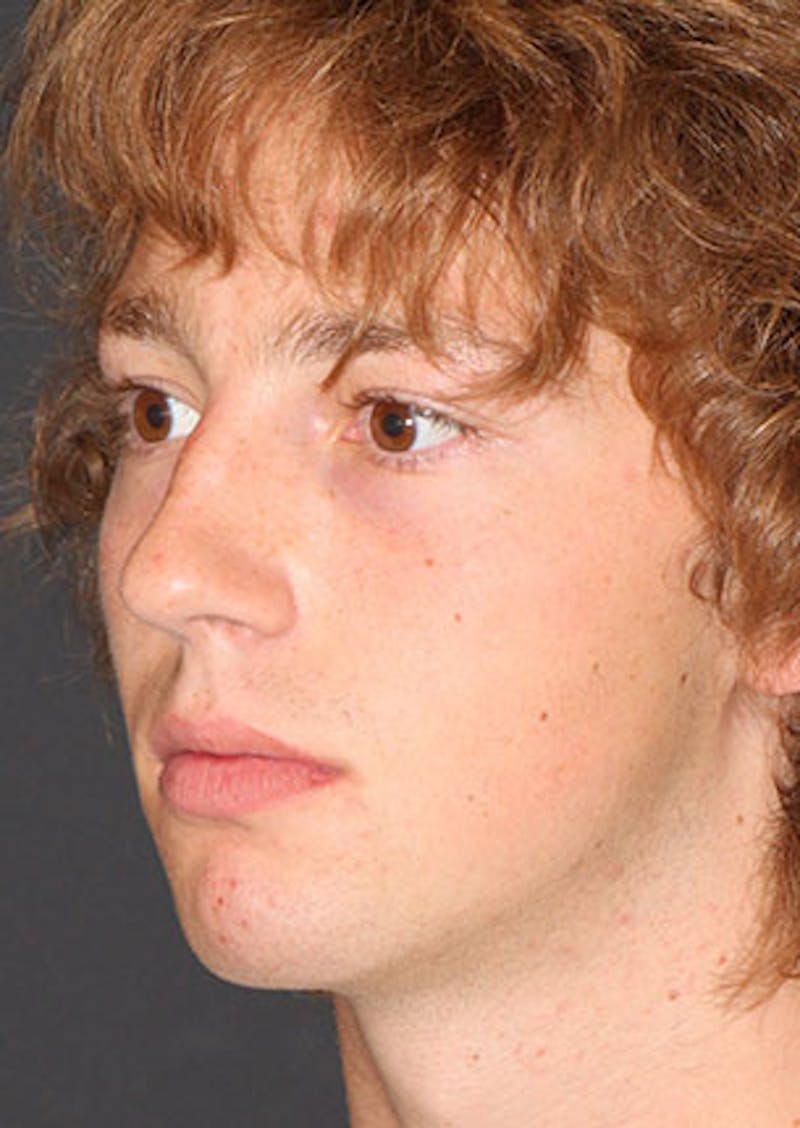 Rhinoplasty Before & After Gallery - Patient 106569327 - Image 7