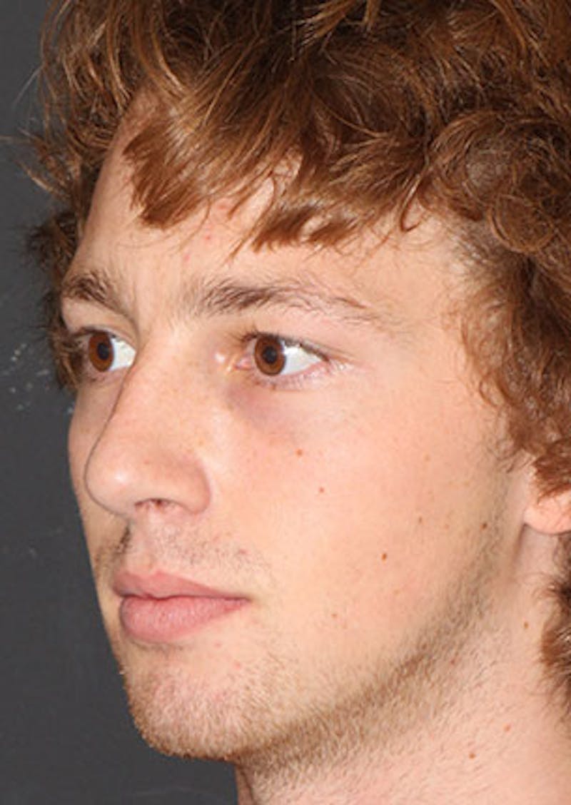 Rhinoplasty Before & After Gallery - Patient 106569327 - Image 8