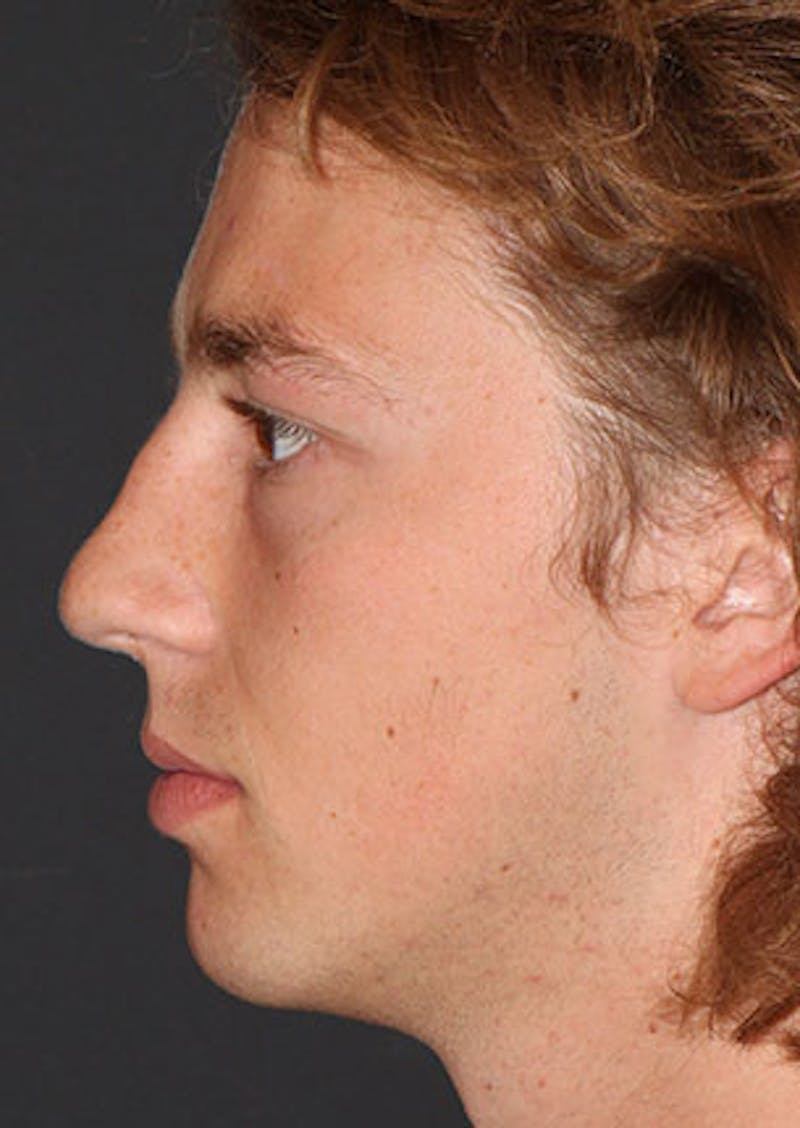 Rhinoplasty Before & After Gallery - Patient 106569327 - Image 9