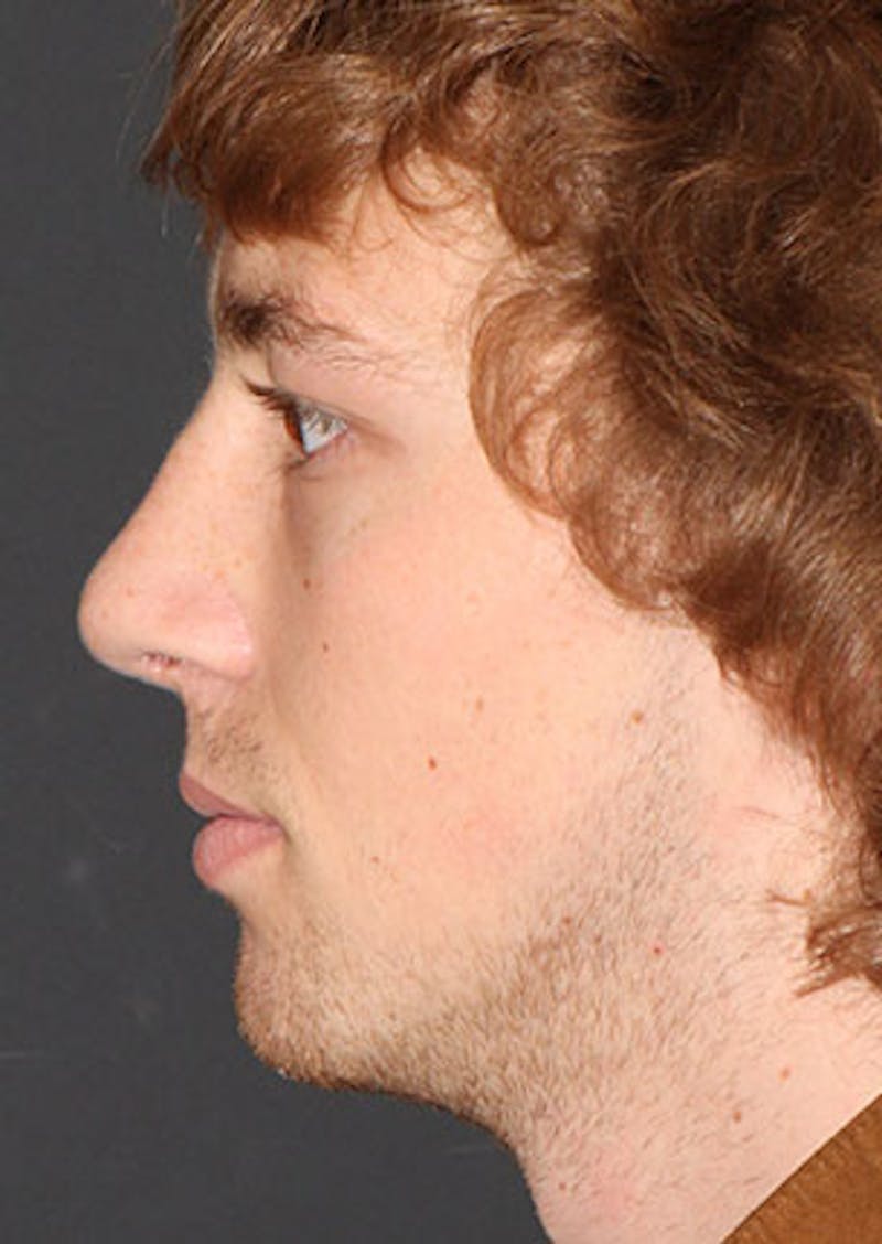 Rhinoplasty Before & After Gallery - Patient 106569327 - Image 10