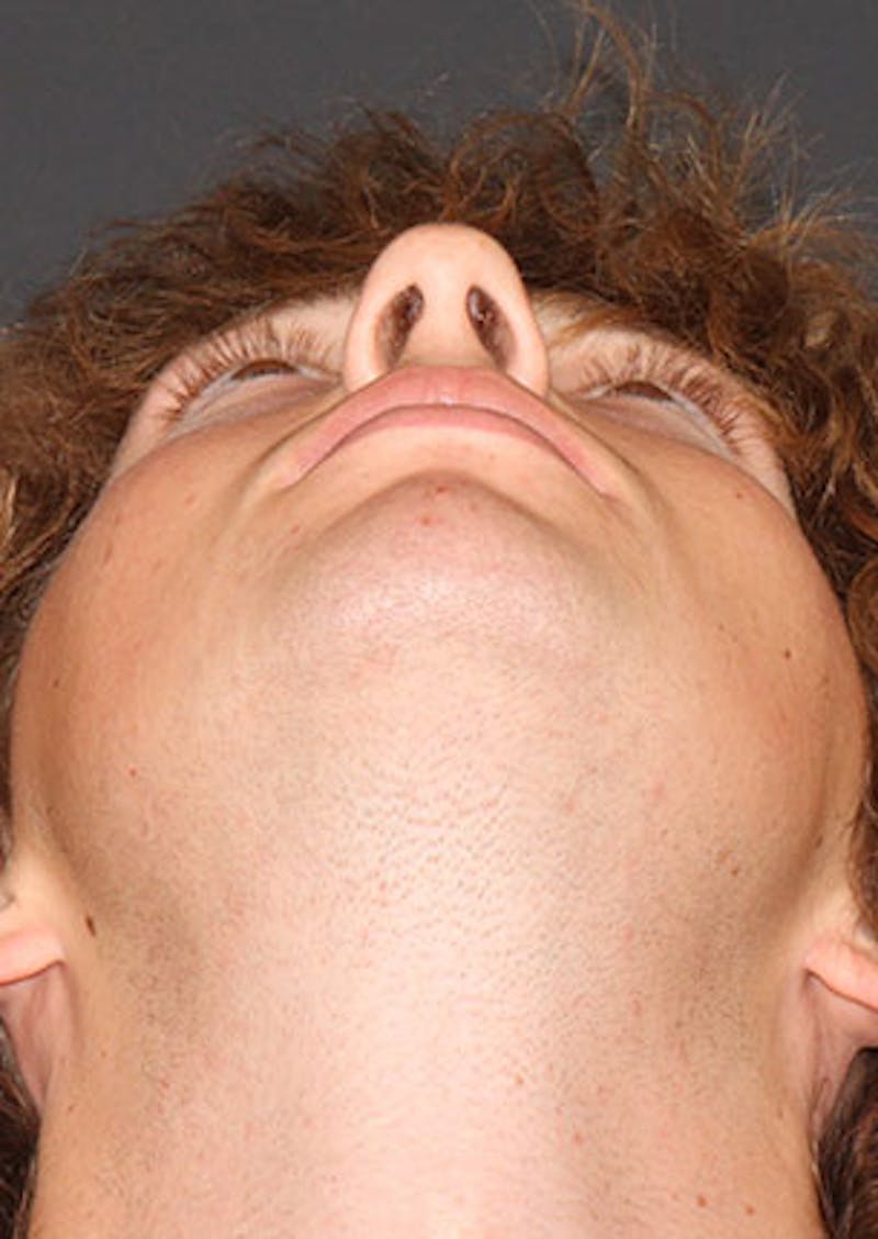 Rhinoplasty Before & After Gallery - Patient 106569327 - Image 11