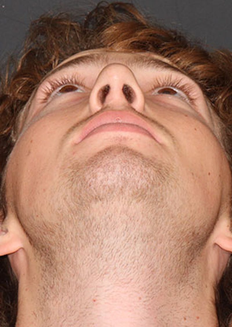 Rhinoplasty Before & After Gallery - Patient 106569327 - Image 12