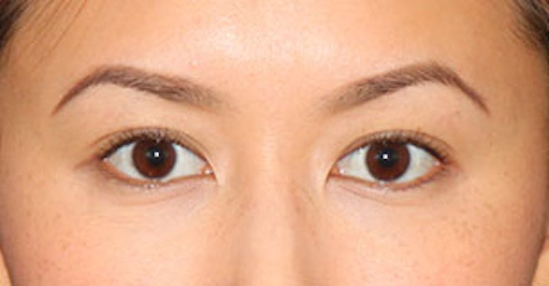 Asian (Double) Eyelid Before & After Gallery - Patient 106569372 - Image 2