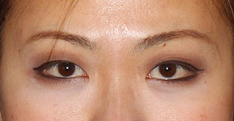 Asian (Double) Eyelid Before & After Gallery - Patient 106569373 - Image 1