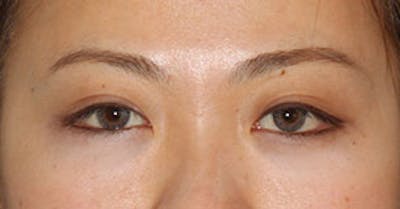 Asian (Double) Eyelid Before & After Gallery - Patient 106569373 - Image 2