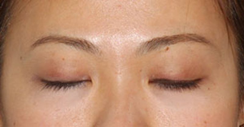 Asian (Double) Eyelid Before & After Gallery - Patient 106569373 - Image 4