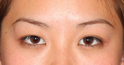 Asian (Double) Eyelid Before & After Gallery - Patient 106569374 - Image 1
