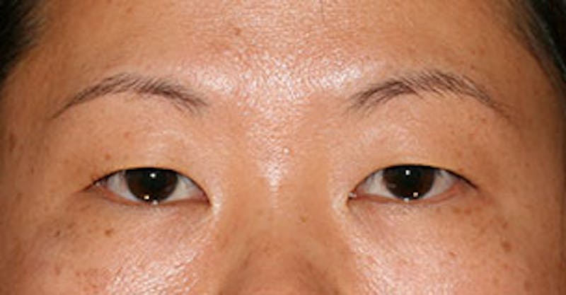 Asian (Double) Eyelid Before & After Gallery - Patient 106569375 - Image 1
