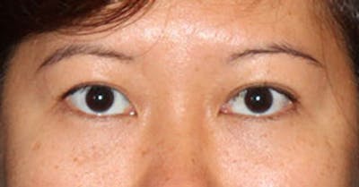 Asian (Double) Eyelid Before & After Gallery - Patient 106569376 - Image 1