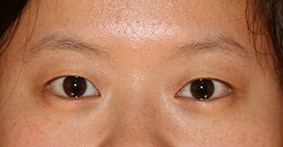 Asian (Double) Eyelid Before & After Gallery - Patient 106569378 - Image 1