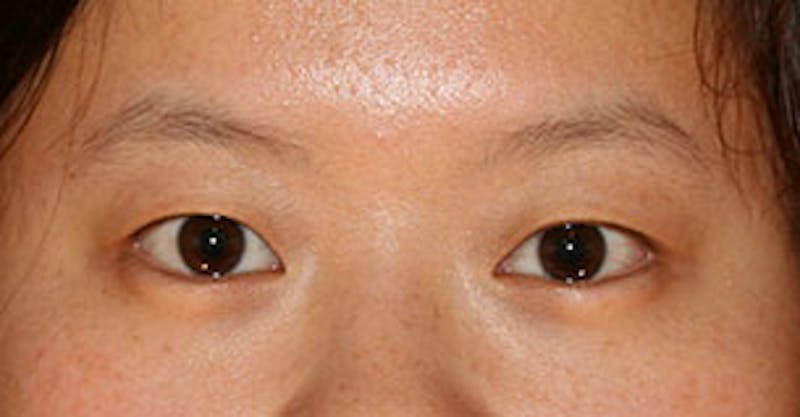 Asian (Double) Eyelid Before & After Gallery - Patient 106569378 - Image 1
