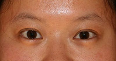 Asian (Double) Eyelid Before & After Gallery - Patient 106569378 - Image 2