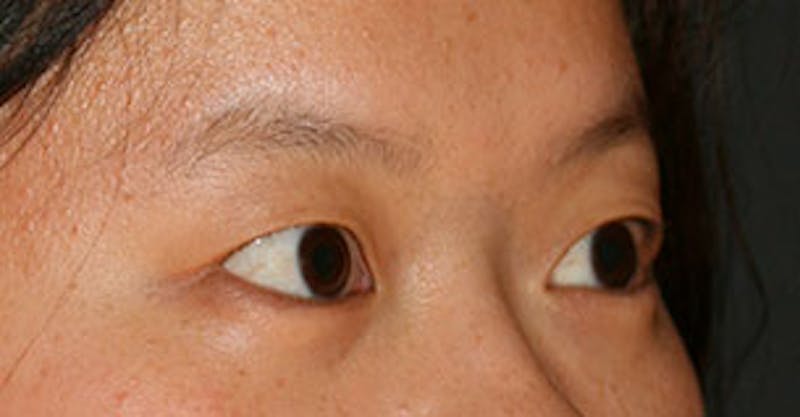 Asian (Double) Eyelid Before & After Gallery - Patient 106569378 - Image 3
