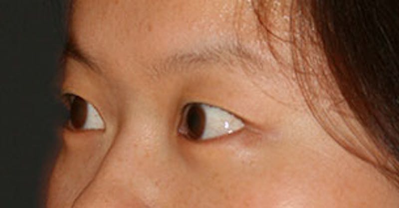 Asian (Double) Eyelid Before & After Gallery - Patient 106569378 - Image 5
