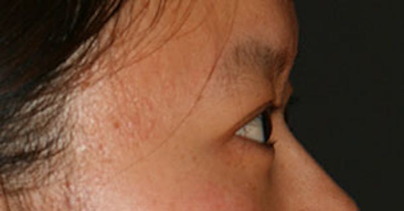 Asian (Double) Eyelid Before & After Gallery - Patient 106569378 - Image 8