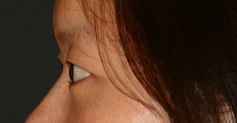 Asian (Double) Eyelid Before & After Gallery - Patient 106569378 - Image 9