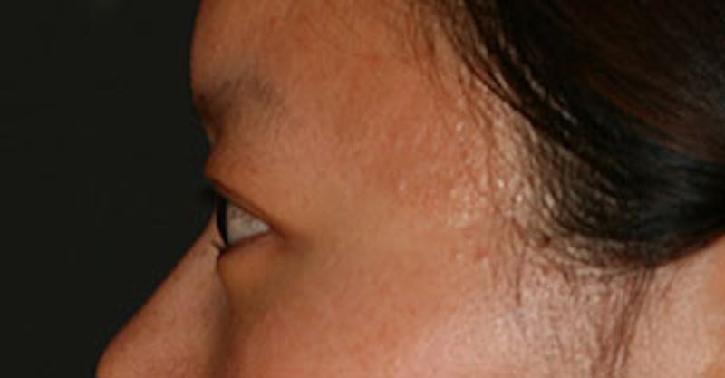 Asian (Double) Eyelid Before & After Gallery - Patient 106569378 - Image 10