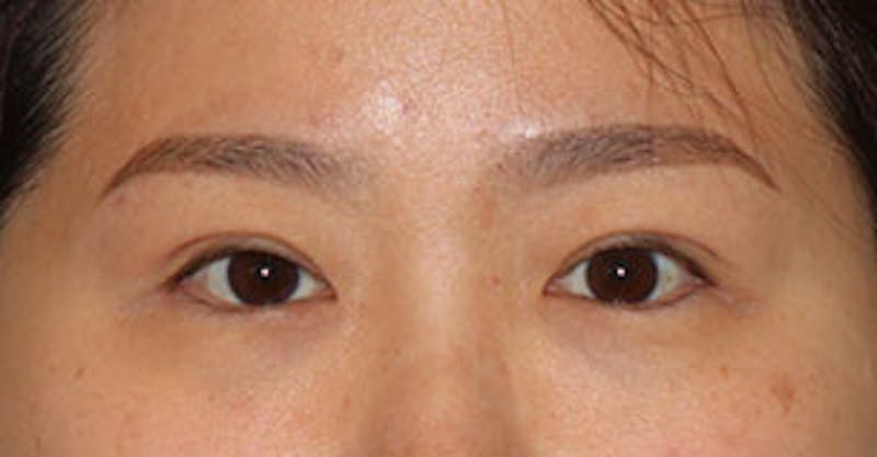 Asian (Double) Eyelid Before & After Gallery - Patient 106569379 - Image 2