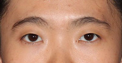 Asian (Double) Eyelid Before & After Gallery - Patient 106569380 - Image 1