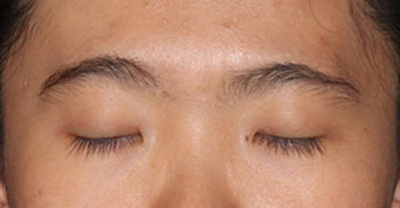 Asian (Double) Eyelid Before & After Gallery - Patient 106569380 - Image 3