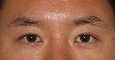 Asian (Double) Eyelid Before & After Gallery - Patient 106569384 - Image 2