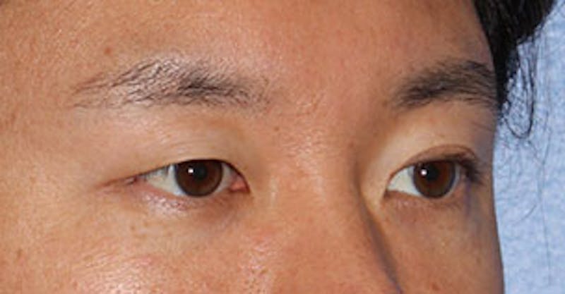Asian (Double) Eyelid Before & After Gallery - Patient 106569384 - Image 3