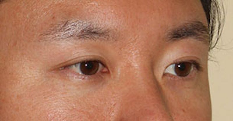 Asian (Double) Eyelid Gallery - Patient 106569384 - Image 4