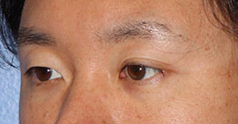 Asian (Double) Eyelid Before & After Gallery - Patient 106569384 - Image 5