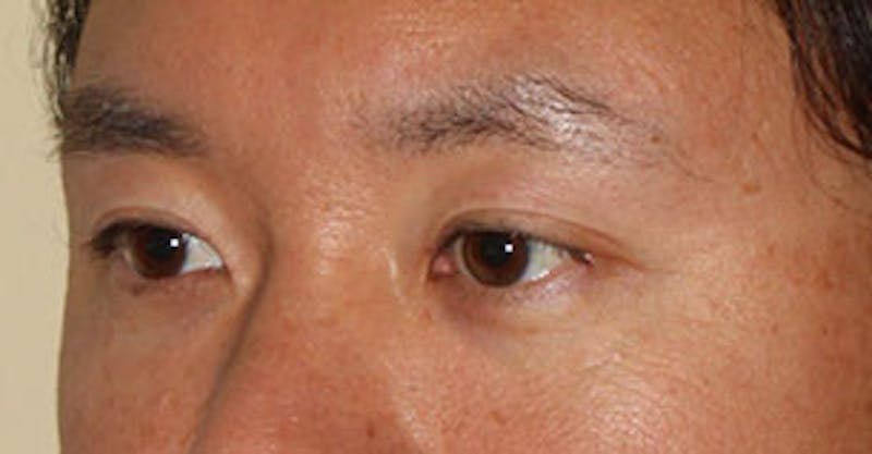 Asian (Double) Eyelid Before & After Gallery - Patient 106569384 - Image 6