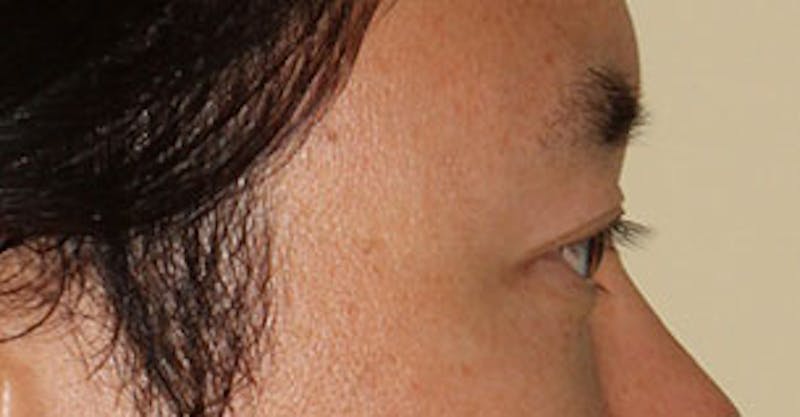 Asian (Double) Eyelid Before & After Gallery - Patient 106569384 - Image 8