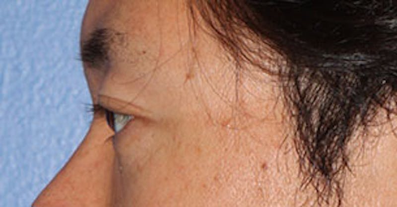 Asian (Double) Eyelid Before & After Gallery - Patient 106569384 - Image 9