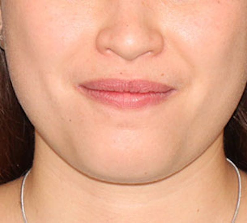 Neck Liposuction Before & After Gallery - Patient 106569393 - Image 1