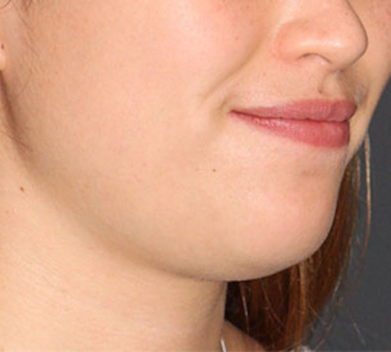 Neck Liposuction Before & After Gallery - Patient 106569393 - Image 3