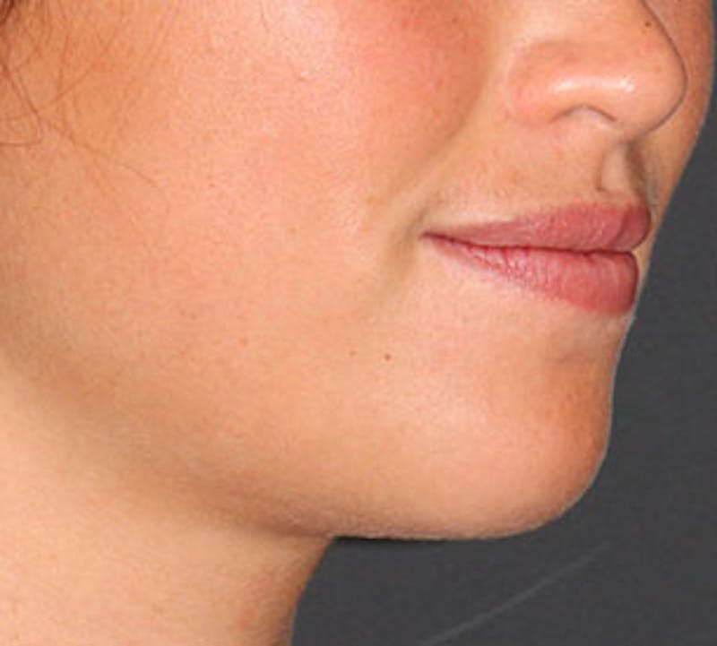 Neck Liposuction Before & After Gallery - Patient 106569393 - Image 4