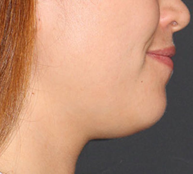 Neck Liposuction Before & After Gallery - Patient 106569393 - Image 7