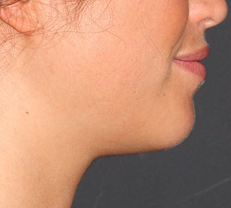 Neck Liposuction Before & After Gallery - Patient 106569393 - Image 8