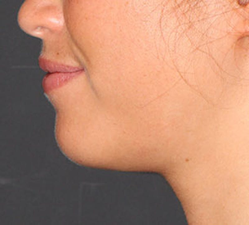 Neck Liposuction Before & After Gallery - Patient 106569393 - Image 10