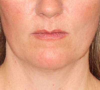 Neck Liposuction Before & After Gallery - Patient 106569396 - Image 1