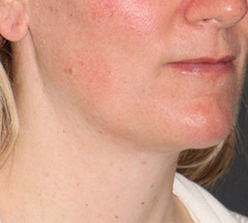 Neck Liposuction Before & After Gallery - Patient 106569396 - Image 4